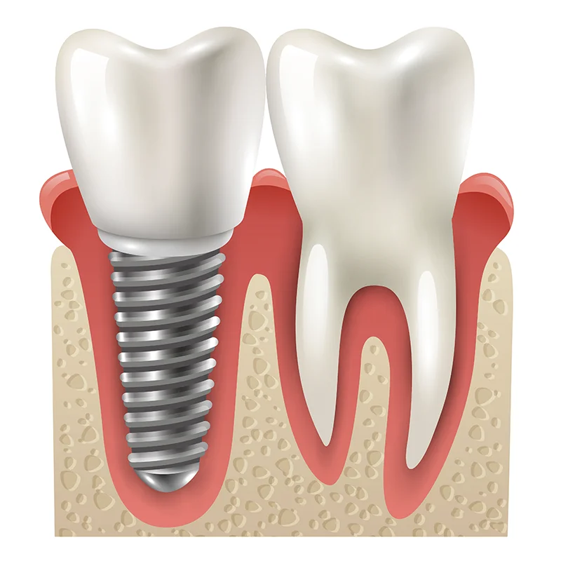 IMPLANTES